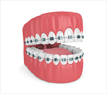 Lingual Braces & Combination - Mount Elizabeth Orthodontic Clinic